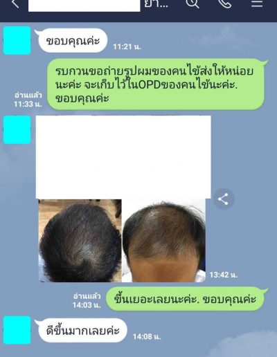 review-hair-loss-02